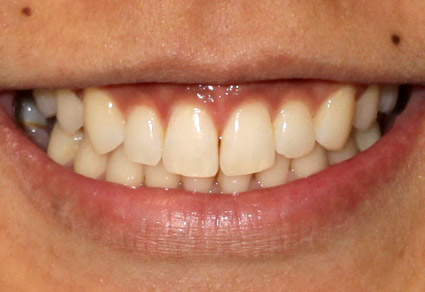 cedar grove dental after results