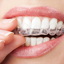 invisalign clear aligners near me