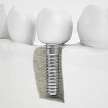 top rated dental restorations
