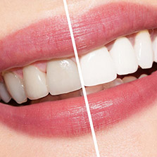 teeth whitening solutions near me