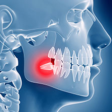 wisdom teeth services near me